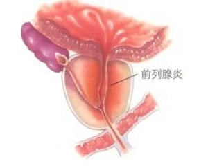 前列腺炎